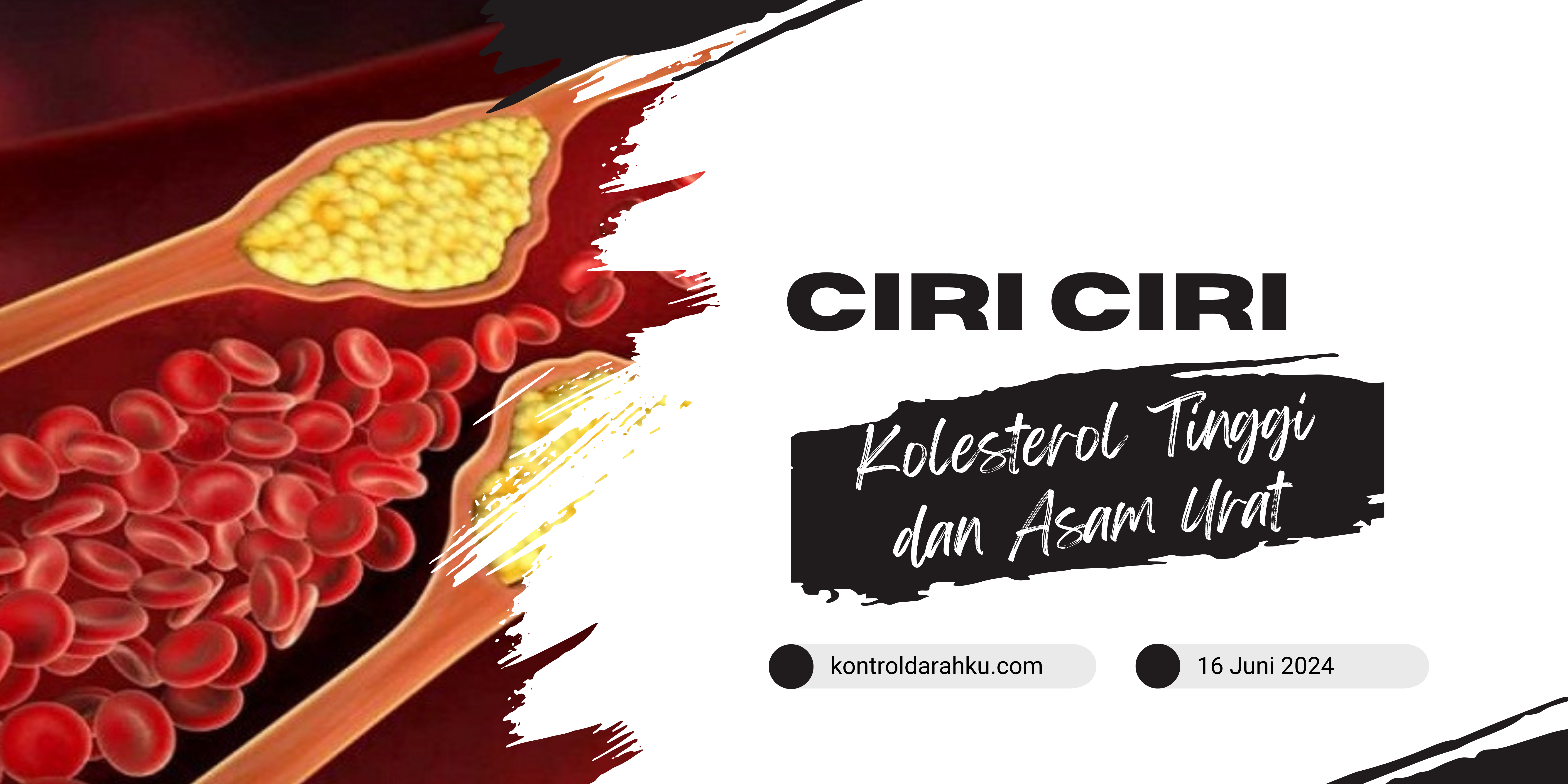 Ciri-Ciri Kolesterol Tinggi dan Asam Urat