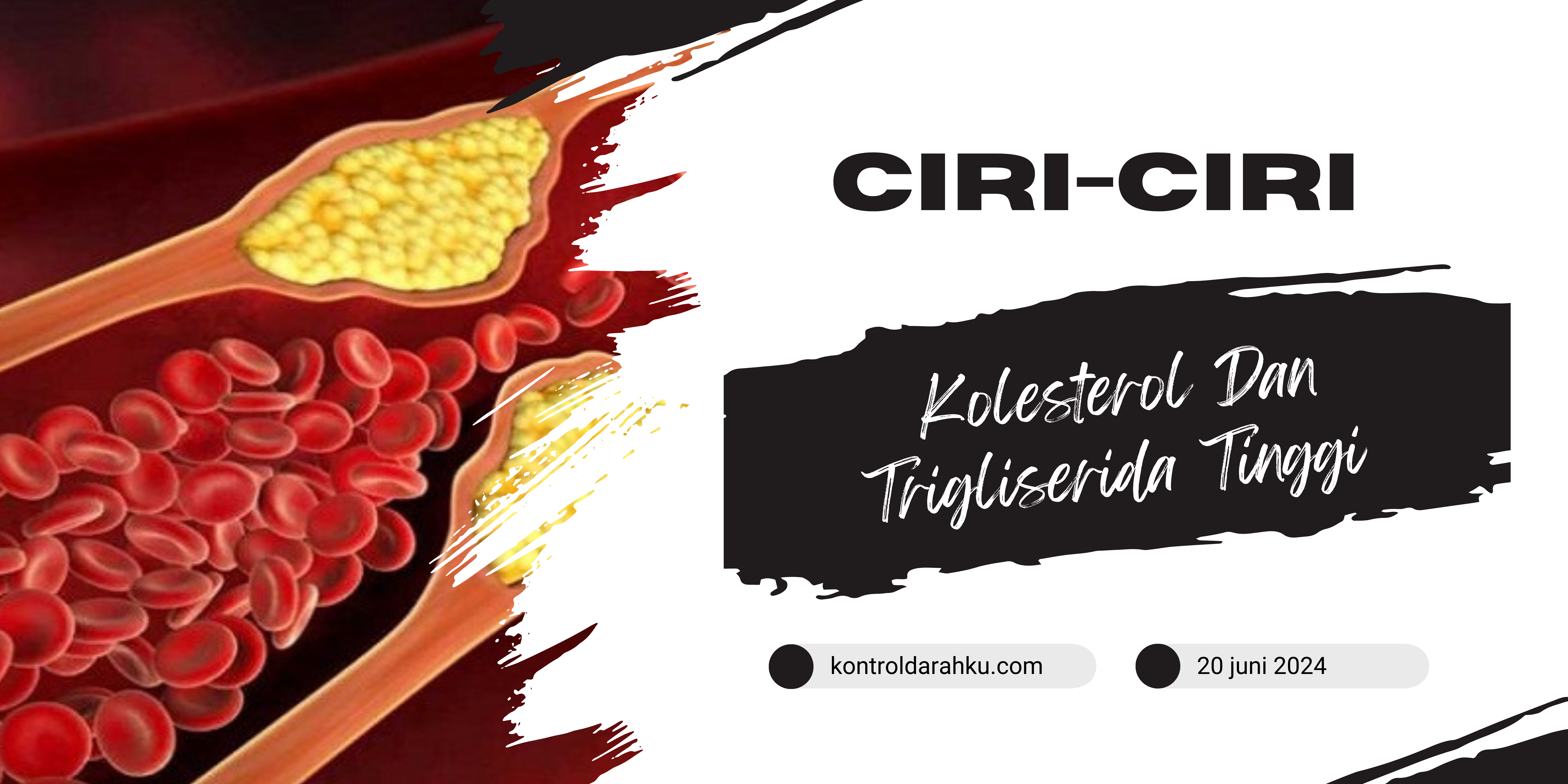 Ciri-Ciri Kolesterol Dan Trigliserida Tinggi