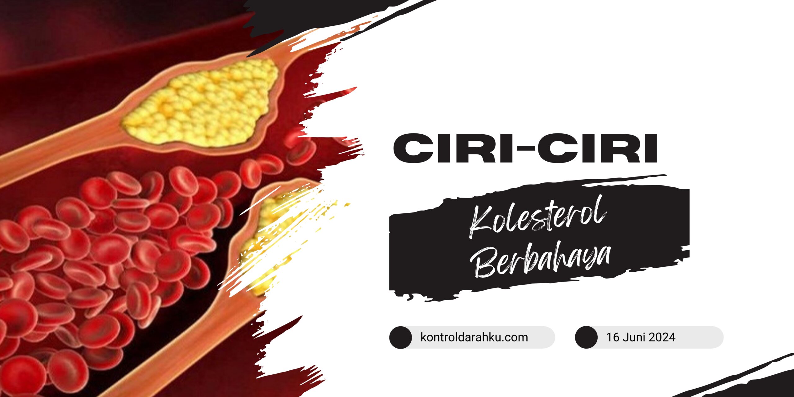 Ciri-Ciri Kolesterol Berbahaya