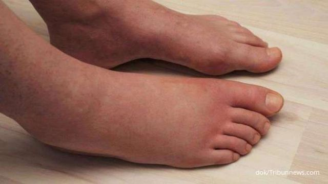 penyebab kaki bengkak diabetes