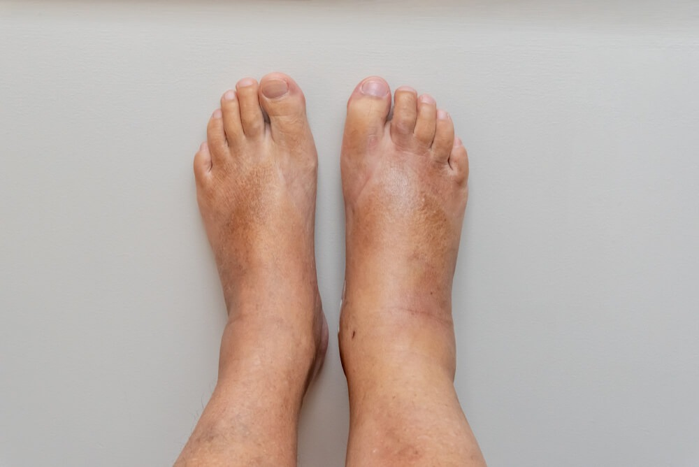 gejala kaki bengkak diabetes