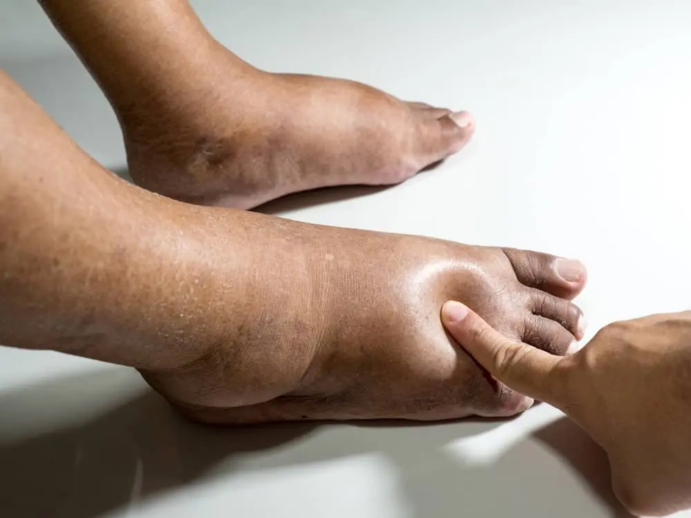 cara mengatasi kaki bengkak diabetes