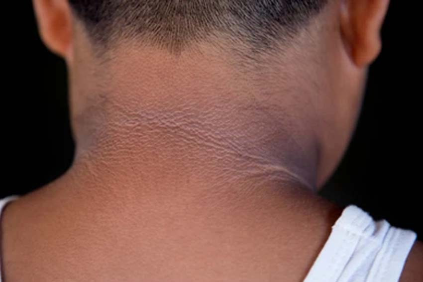 Mengapa Leher Hitam Diabetes Bisa Terjadi