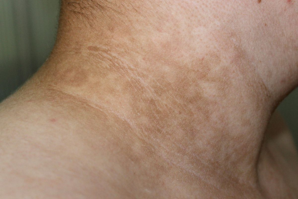 Cara Mengatasi Leher Hitam Diabetes