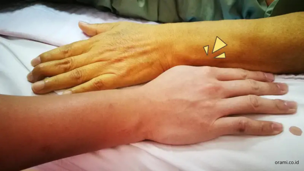 Benarkah Kulit Menguning Selalu Berbahaya? Penyakit Kuning Adalah